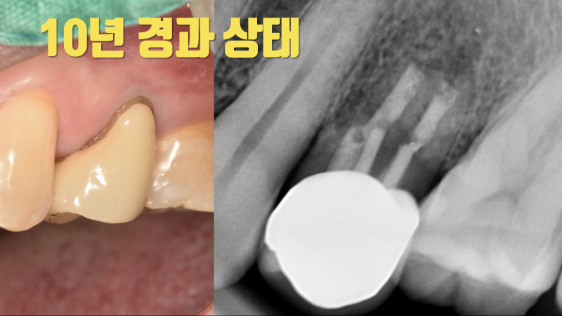 다 부서지고 뿌리만 남은 치아 10년 이상 살린 증례 #치아살리기 #치아재식술