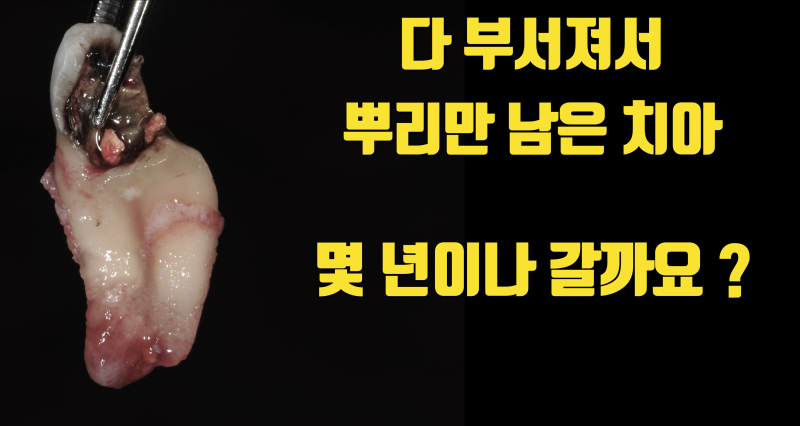 다 부서지고 뿌리만 남은 치아 10년 이상 살린 증례 #치아살리기 #치아재식술