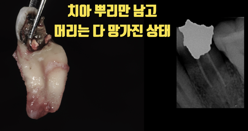다 부서지고 뿌리만 남은 치아 10년 이상 살린 증례 #치아살리기 #치아재식술 사진 2