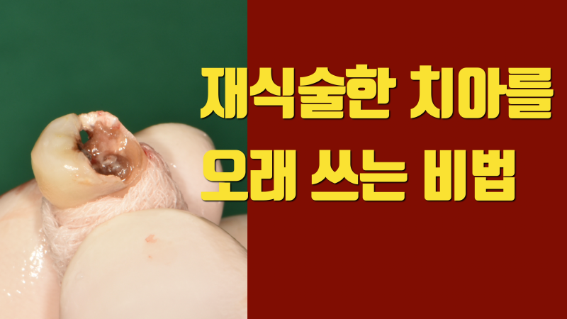 재식술 치아 수명, 제대로 한 재식술 치아는 오래 갑니다 #치아재식술 #의도적재식술