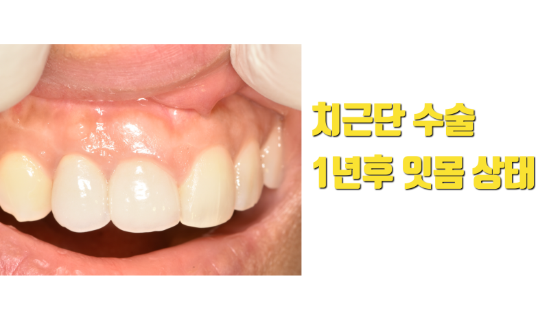 예쁘게 하는게 제일 중요한 치근단 수술 #치근단수술 #치근단절제술 사진 3