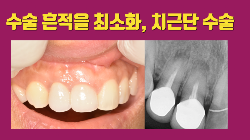예쁘게 하는게 제일 중요한 치근단 수술 #치근단수술 #치근단절제술