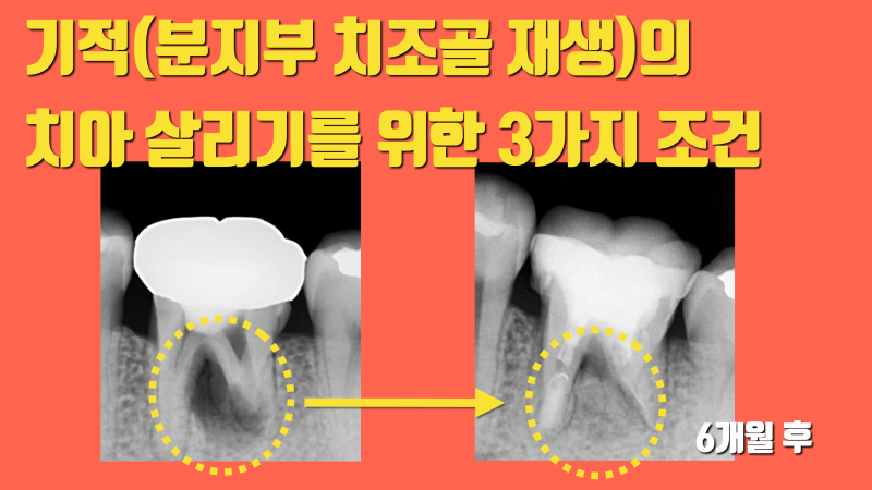 기분이가 좋아서... 재식술로 분지부 치조골 재생 자랑하기 #치아재식술 #의도적재식술