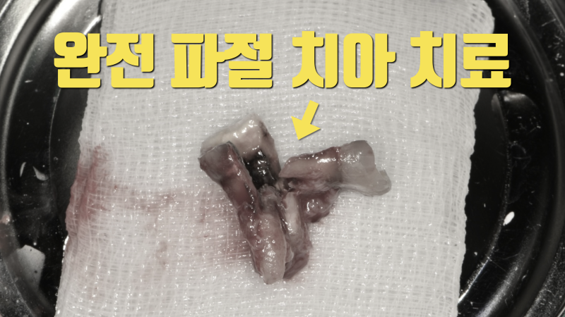 완전 파절치아의 치료, 파절치아 재식술 #치아재식술 #의도적재식술