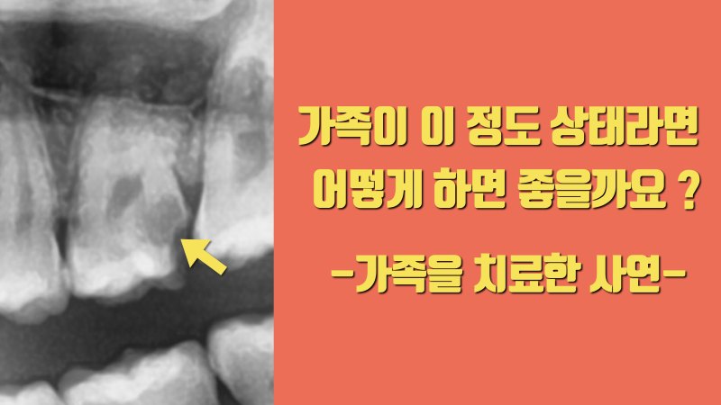 가족의 충치는 어떻게 치료할까 ? #치아살리기 #최용훈원장