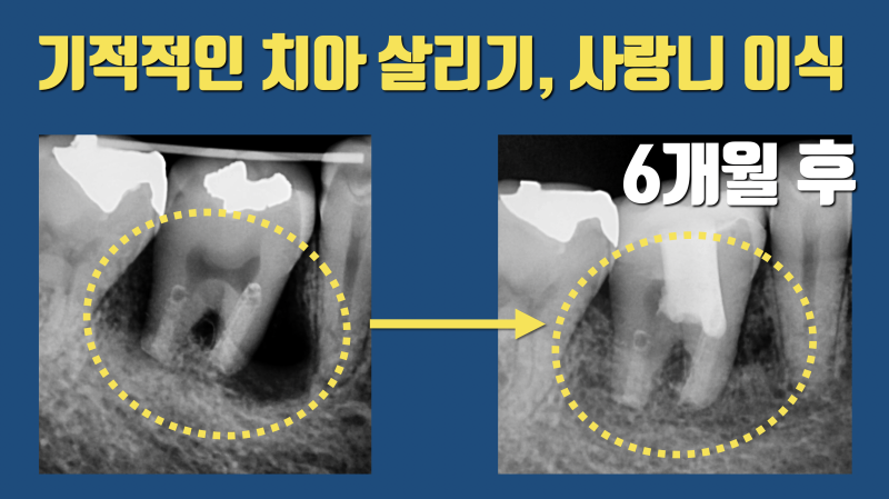 기적이라 부르고 싶은 치료, 사랑니 이식술 #사랑니이식 #치아이식