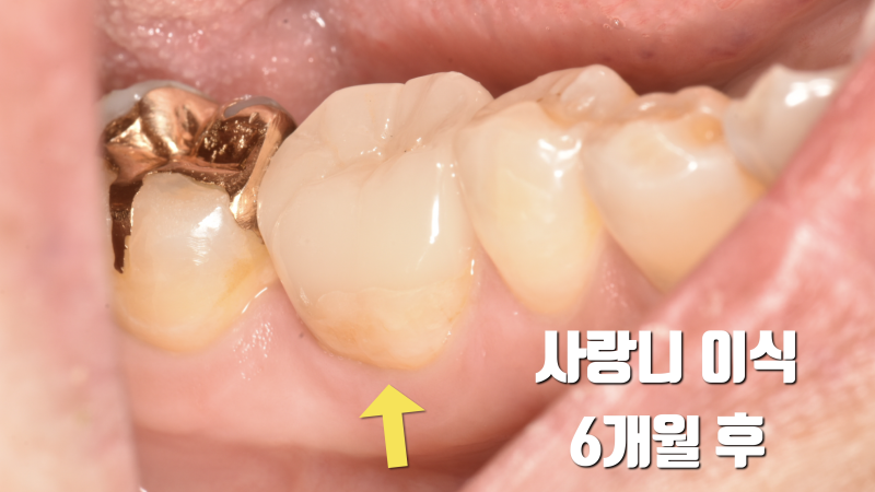 기적이라 부르고 싶은 치료, 사랑니 이식술 #사랑니이식 #치아이식