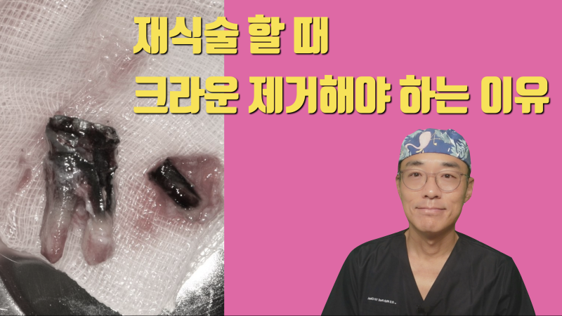 재식술 크라운을 벗겨야 하는 이유 #재식술 #치아재식술 #의도적재식술