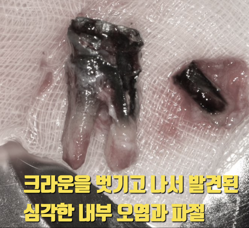 재식술 크라운을 벗겨야 하는 이유 #재식술 #치아재식술 #의도적재식술