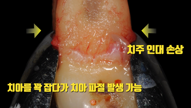 재식술할 때 쓰면 안되는 기구 #치아재식술 #의도적재식술