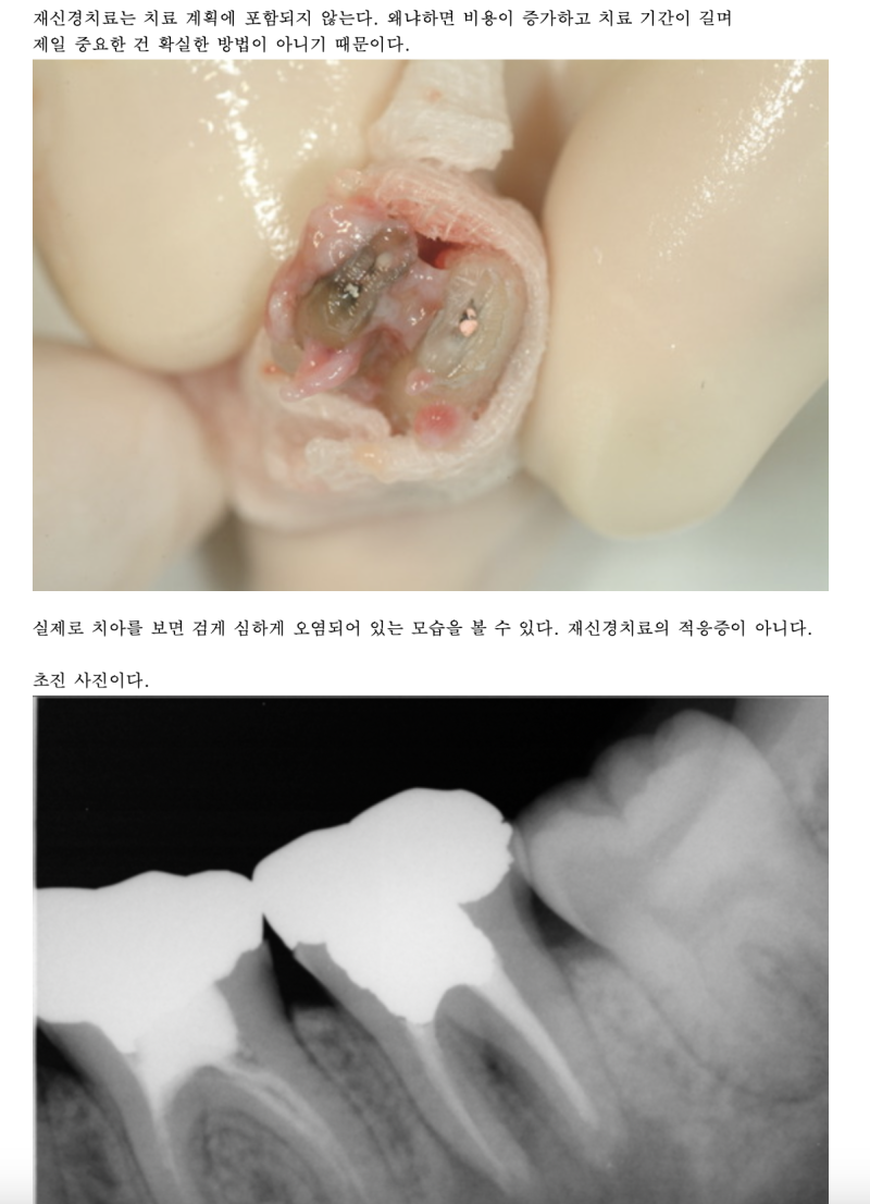 20년전부터 하고 있는 치아재식술 #재식술 #치아재식술 #의도적재식술 사진 3