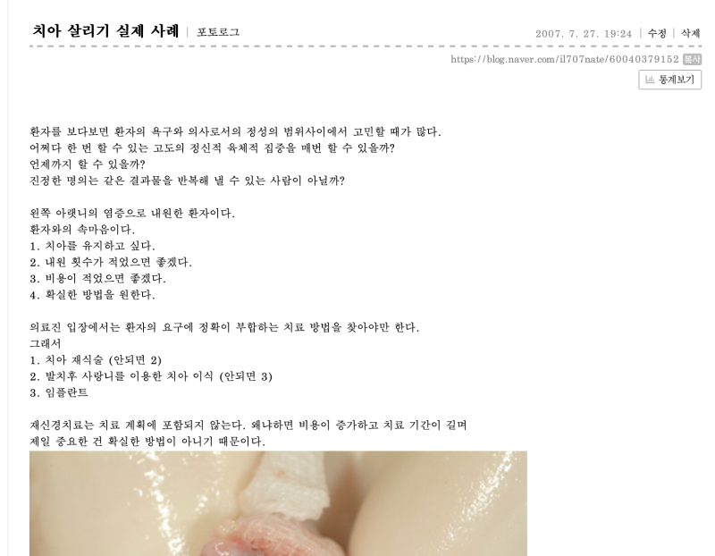 20년전부터 하고 있는 치아재식술 #재식술 #치아재식술 #의도적재식술 사진 2