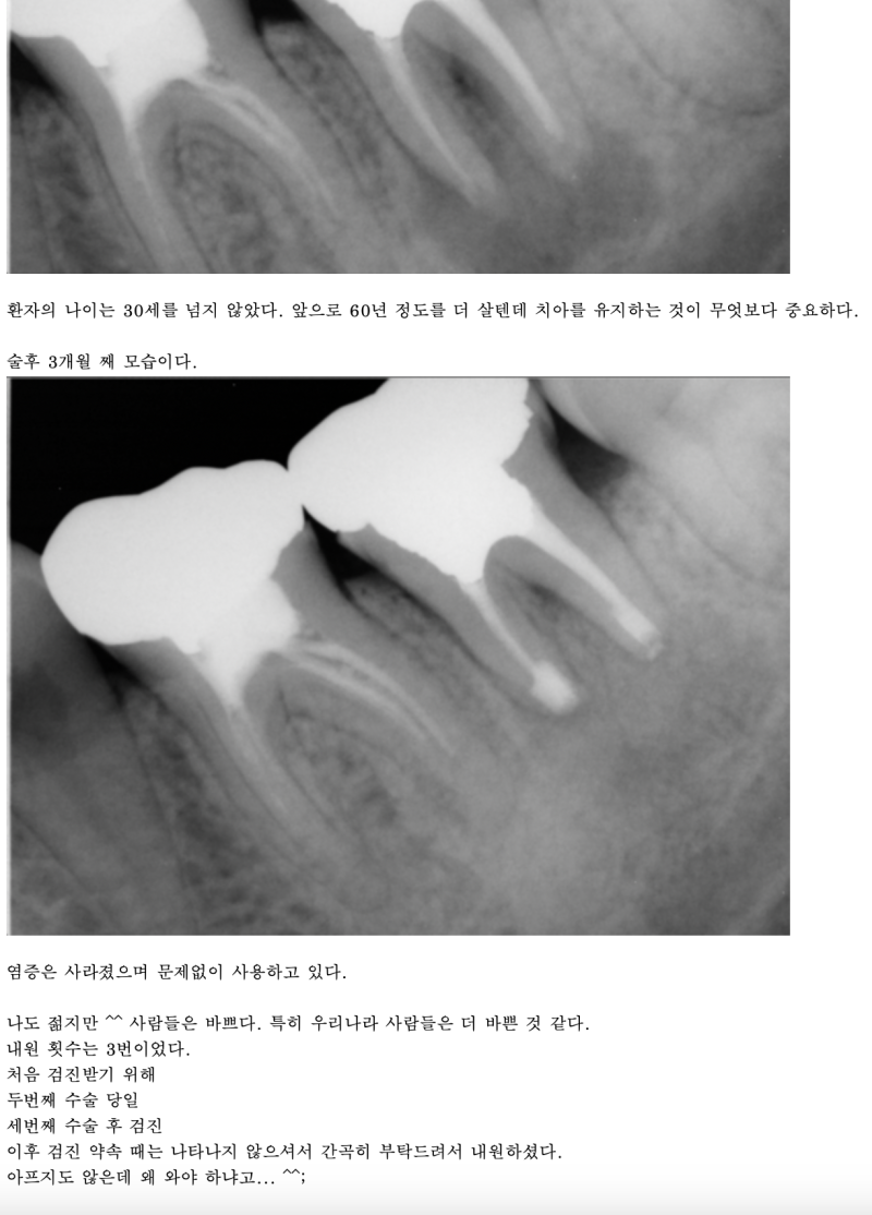 20년전부터 하고 있는 치아재식술 #재식술 #치아재식술 #의도적재식술 사진 4