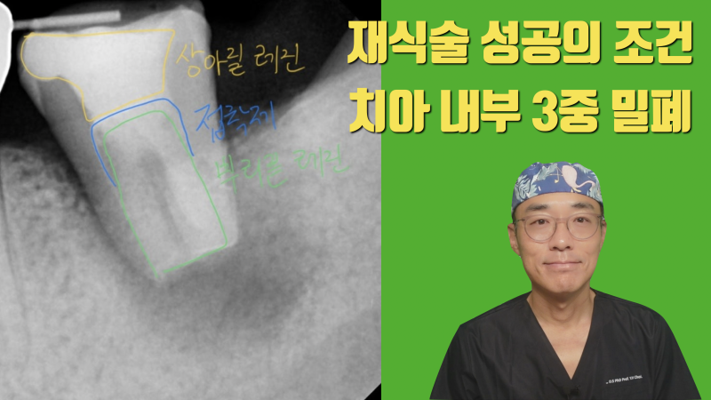 성공적인 재식술을 위해서 치아 내부 3중으로 밀폐하는 방법 #치아재식술 #의도적재식술 #재식술