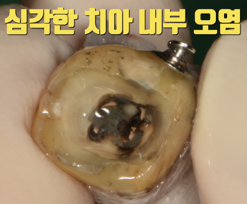 성공적인 재식술을 위해서 치아 내부 3중으로 밀폐하는 방법 #치아재식술 #의도적재식술 #재식술 사진 2