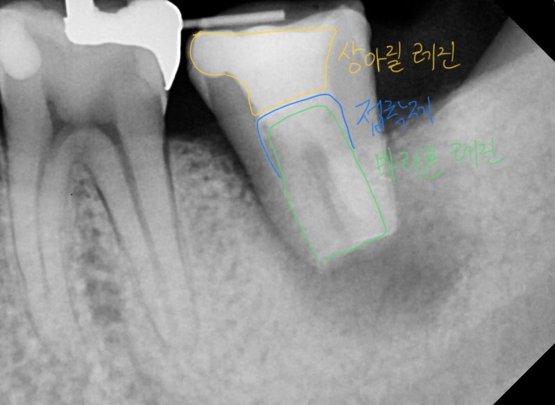성공적인 재식술을 위해서 치아 내부 3중으로 밀폐하는 방법 #치아재식술 #의도적재식술 #재식술 사진 4