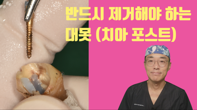 재식술 때 반드시 제거해야 하는 대못(포스트) #재식술 #치아재식술 #의도적재식술