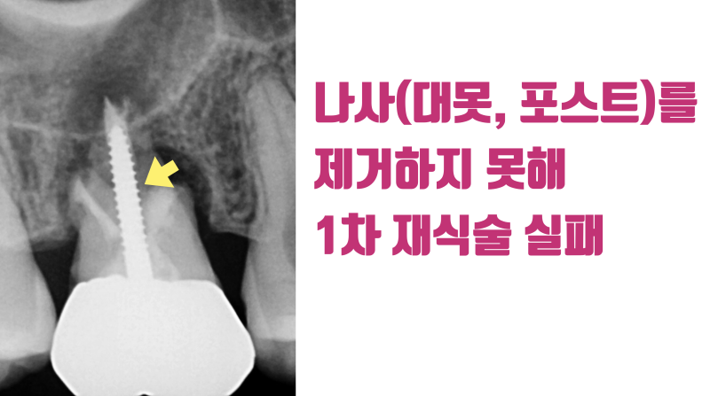 재식술 때 반드시 제거해야 하는 대못(포스트) #재식술 #치아재식술 #의도적재식술 사진 2