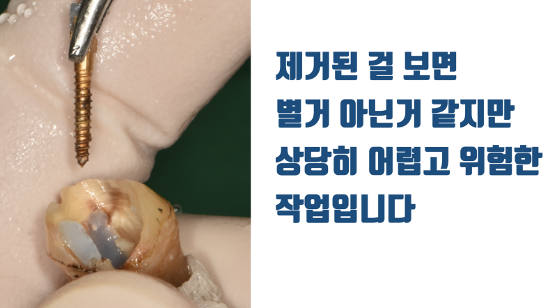 재식술 때 반드시 제거해야 하는 대못(포스트) #재식술 #치아재식술 #의도적재식술