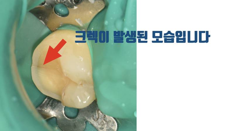 초기 크렉은 신경 치료, 크라운 없이 부분 접착 세라믹으로 치료합니다 #치아살리기 #최용훈원장 사진 2