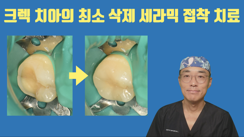 초기 크렉은 신경 치료, 크라운 없이 부분 접착 세라믹으로 치료합니다 #치아살리기 #최용훈원장