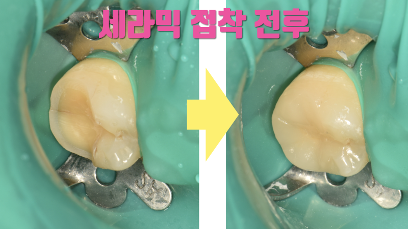 초기 크렉은 신경 치료, 크라운 없이 부분 접착 세라믹으로 치료합니다 #치아살리기 #최용훈원장