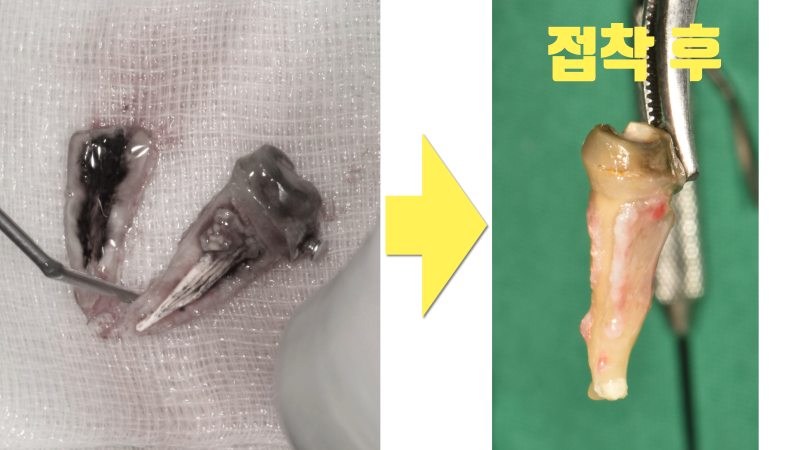 완전 분리된 치아의 접착 재식술 #치아살리기 #최용훈원장