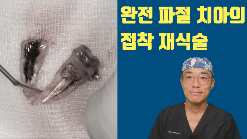 완전 분리된 치아의 접착 재식술 #치아살리기 #최용훈원장