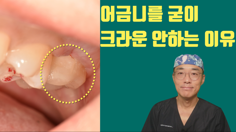 대구치 어금니 크라운 하지 않는 이유 #접착세라믹 #세라믹치료