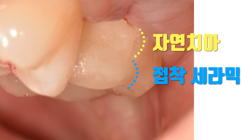 대구치 어금니 크라운 하지 않는 이유 #접착세라믹 #세라믹치료