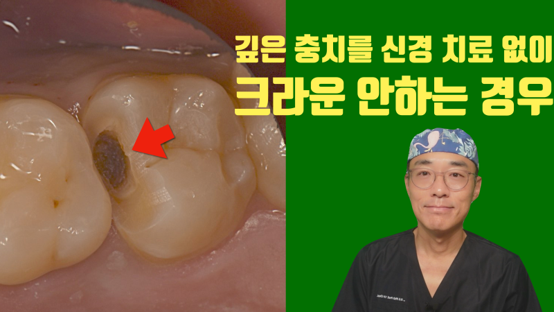 깊은 충치라도 신경 치료를 안할 수 있으면 시도해 봅니다 #최용훈원장 #세라믹치료