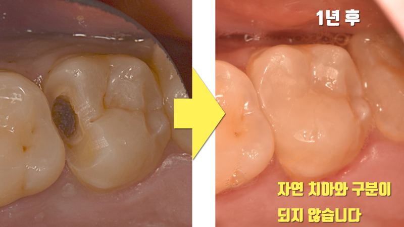 깊은 충치라도 신경 치료를 안할 수 있으면 시도해 봅니다 #최용훈원장 #세라믹치료 사진 3