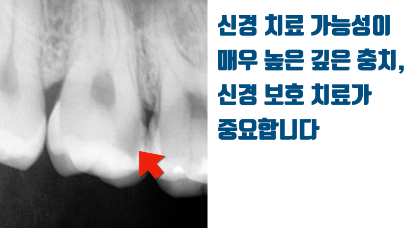 깊은 충치라도 신경 치료를 안할 수 있으면 시도해 봅니다 #최용훈원장 #세라믹치료