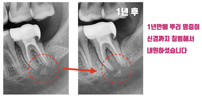나도 해당될 수 있는 시한 폭탄 치아 #재식술 #치아재식술 사진 3