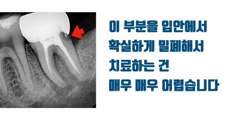 나도 해당될 수 있는 시한 폭탄 치아 #재식술 #치아재식술