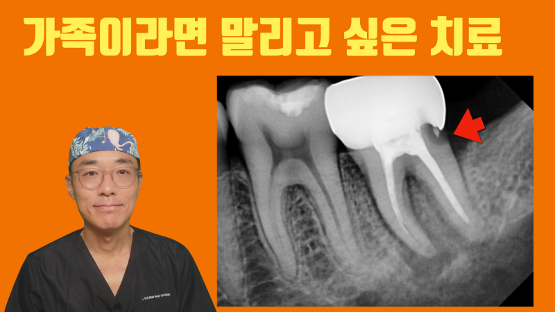 나도 해당될 수 있는 시한 폭탄 치아 #재식술 #치아재식술