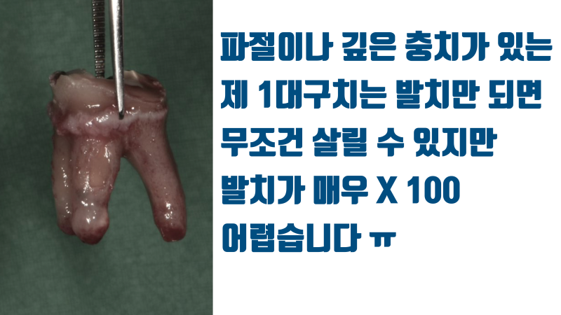 제 1 대구치를 해결하지 못하면 치아 살리기라고 보기 어렵습니다 #재식술 #치아재식술 #치근단수술