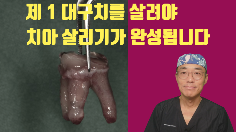 제 1 대구치를 해결하지 못하면 치아 살리기라고 보기 어렵습니다 #재식술 #치아재식술 #치근단수술