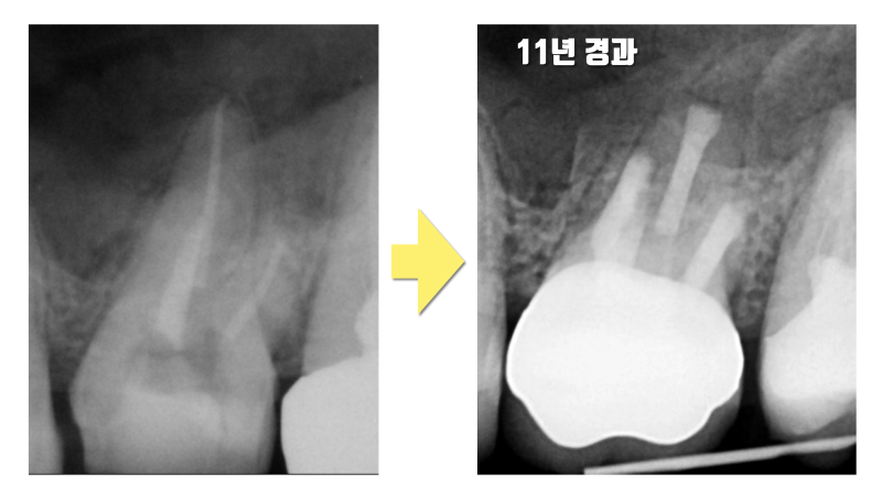 제일 어려운 제 1대구치 재식술 성공 11년 경과 증례 #재식술 #치아재식술 #의도적재식술