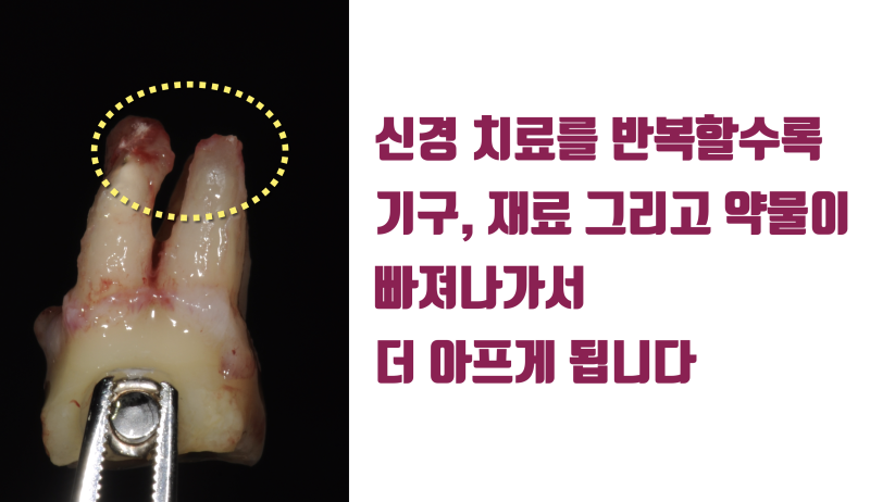 제일 어려운 제 1대구치 재식술 성공 11년 경과 증례 #재식술 #치아재식술 #의도적재식술 사진 3