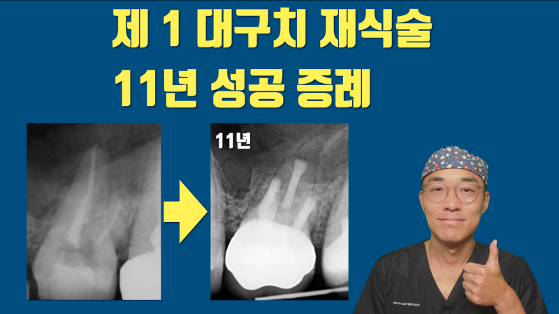 제일 어려운 제 1대구치 재식술 성공 11년 경과 증례 #재식술 #치아재식술 #의도적재식술