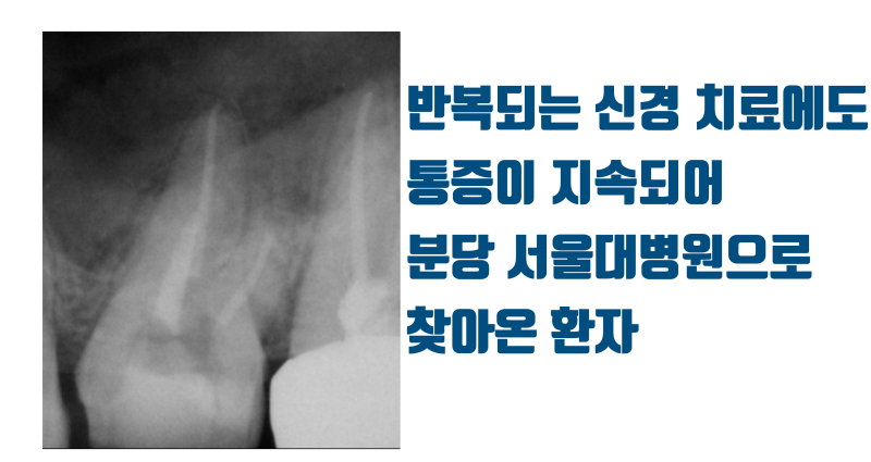 제일 어려운 제 1대구치 재식술 성공 11년 경과 증례 #재식술 #치아재식술 #의도적재식술 사진 2