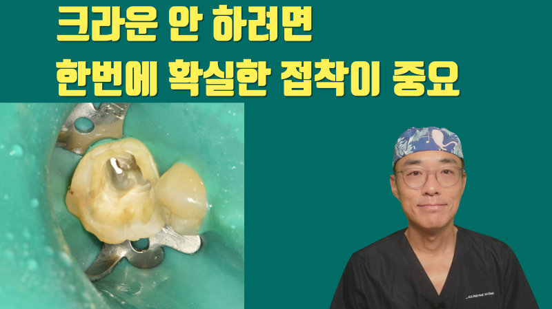 크라운을 안 하려면 치아 내부 처리가 중요합니다 #부분세라믹 #세라믹접착