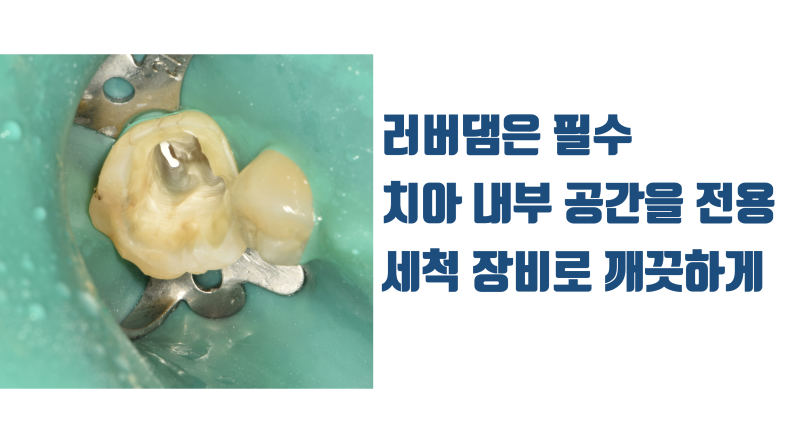 크라운을 안 하려면 치아 내부 처리가 중요합니다 #부분세라믹 #세라믹접착 사진 2