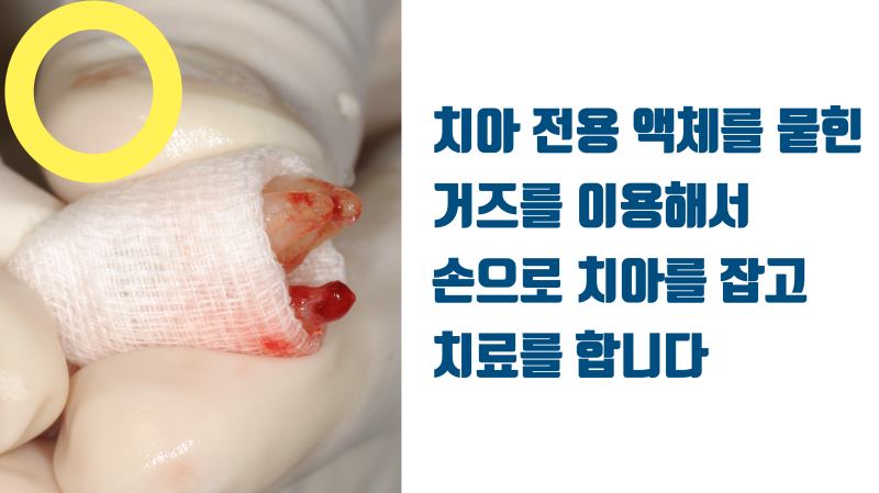 재식술 할 때 치아는 손으로 잡아야 합니다 기구로 잡으면 안됩니다 #재식술 #치아재식술 #의도적재식술 사진 3