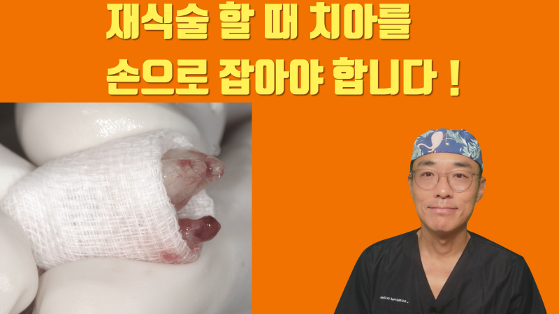 재식술 할 때 치아는 손으로 잡아야 합니다 기구로 잡으면 안됩니다 #재식술 #치아재식술 #의도적재식술