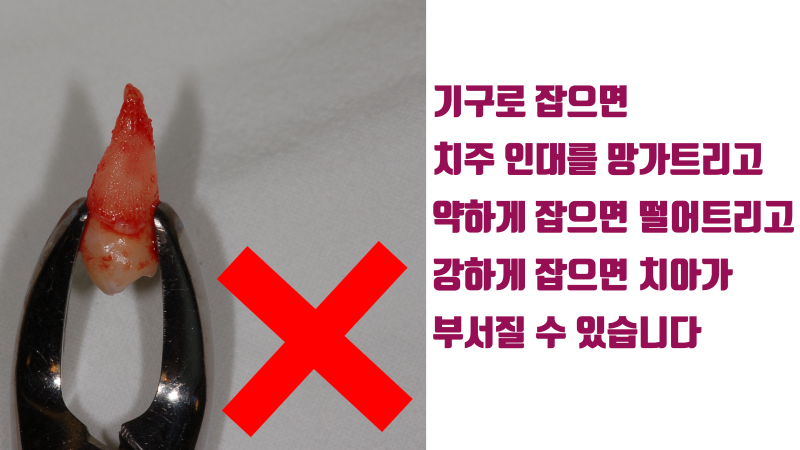 재식술 할 때 치아는 손으로 잡아야 합니다 기구로 잡으면 안됩니다 #재식술 #치아재식술 #의도적재식술