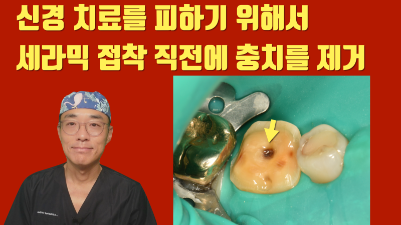 신경 치료와 크라운을 하지 않는 방법, 세라믹 접착 직전에 마지막 충치를 제거합니다 #치아살리기 #최용훈원장