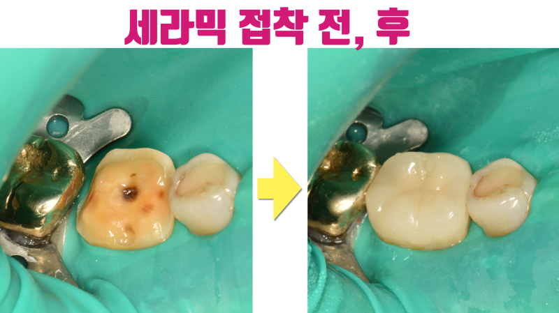 신경 치료와 크라운을 하지 않는 방법, 세라믹 접착 직전에 마지막 충치를 제거합니다 #치아살리기 #최용훈원장