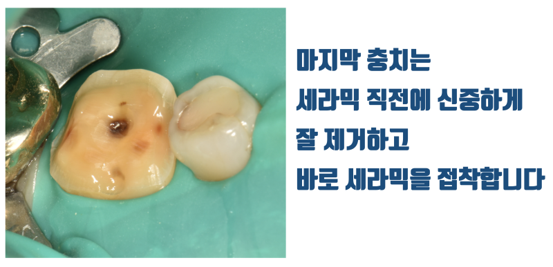 신경 치료와 크라운을 하지 않는 방법, 세라믹 접착 직전에 마지막 충치를 제거합니다 #치아살리기 #최용훈원장 사진 2